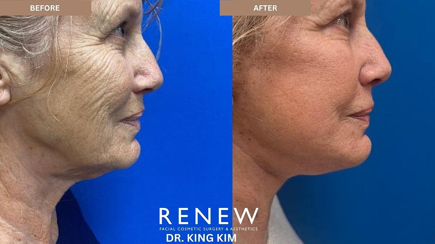 Deep Plane Facelift Before & After