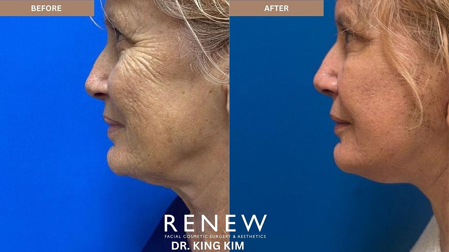 Deep Plane Facelift Before & After