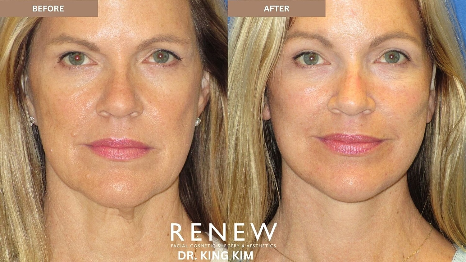 Deep Plane Facelift Before & After