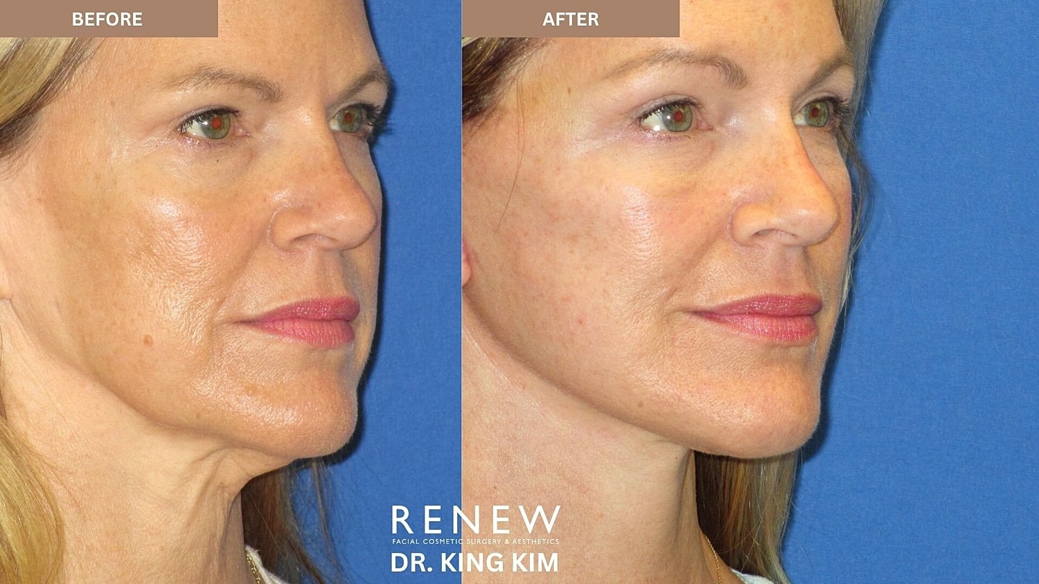 Deep Plane Facelift Before & After