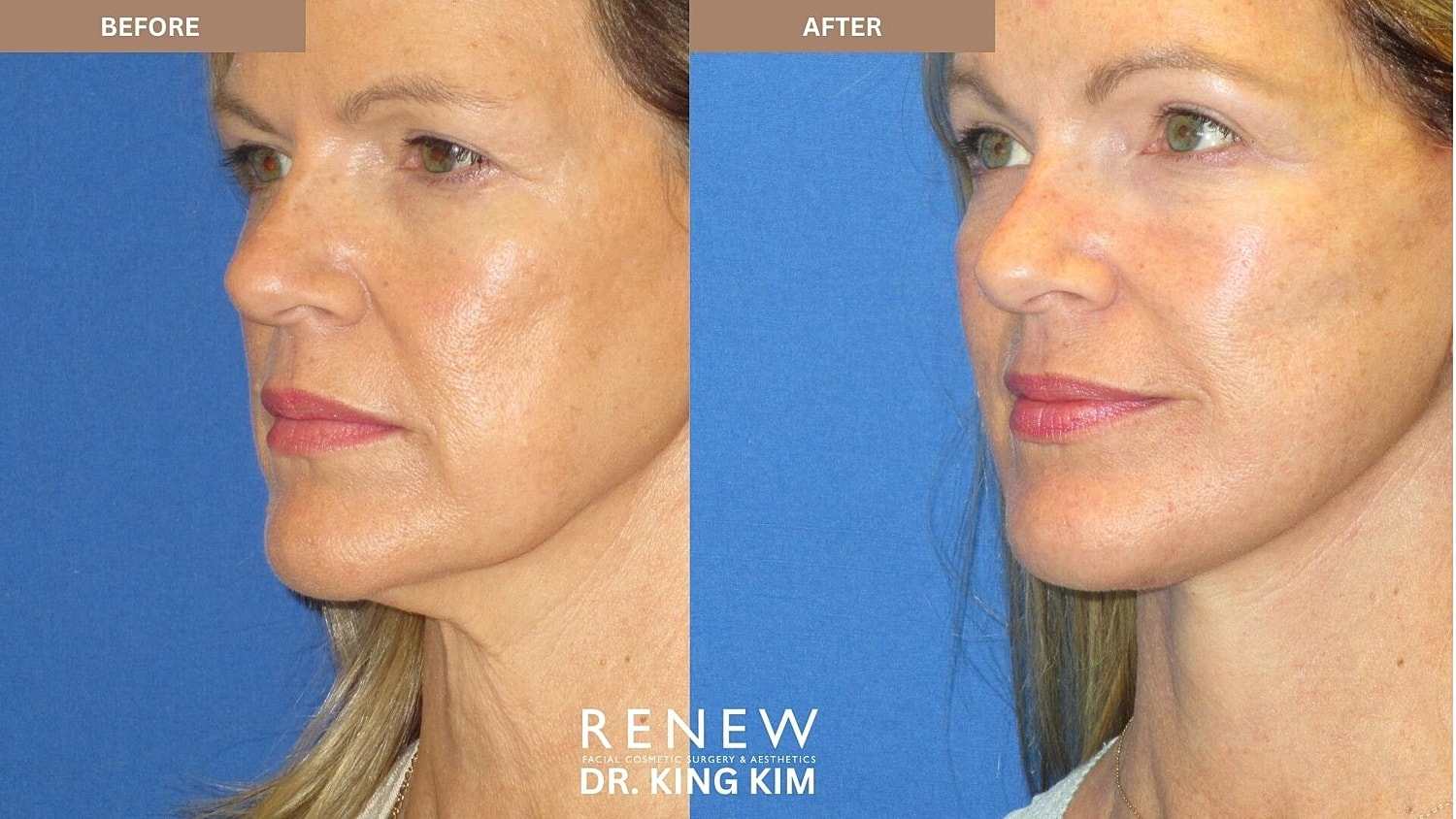 Deep Plane Facelift Before & After