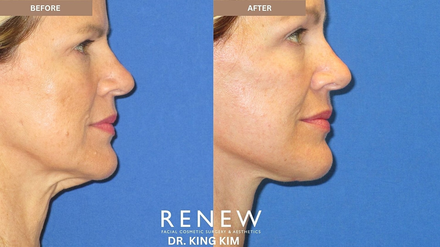 Deep Plane Facelift Before & After