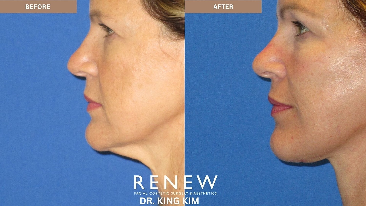 Deep Plane Facelift Before & After