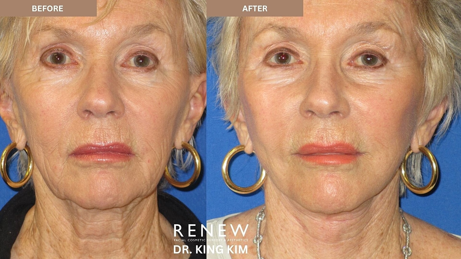 Deep Plane Facelift Before & After