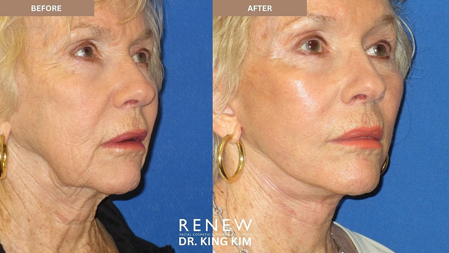 Deep Plane Facelift Before & After