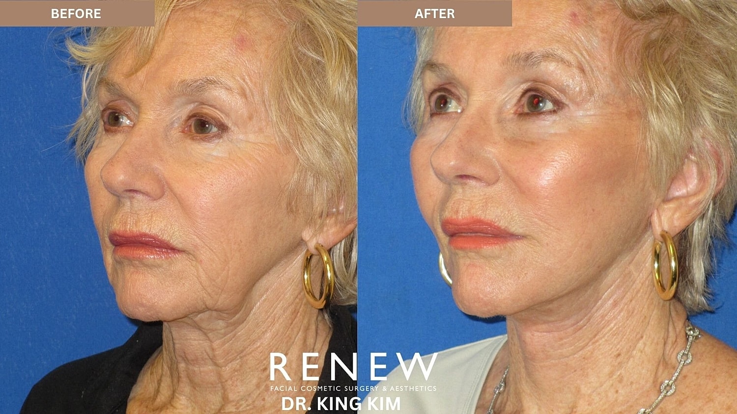 Deep Plane Facelift Before & After