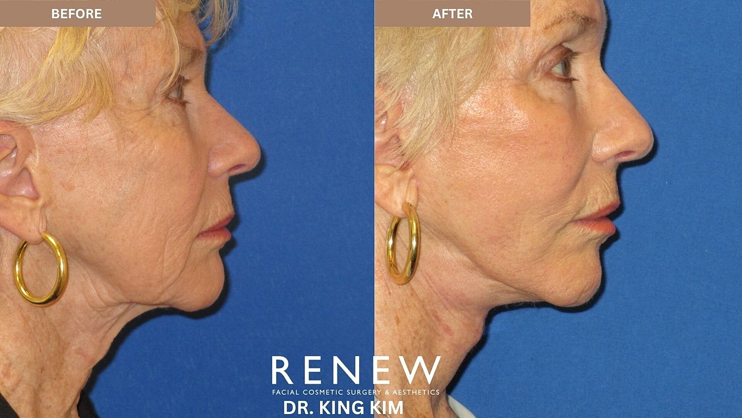 Deep Plane Facelift Before & After