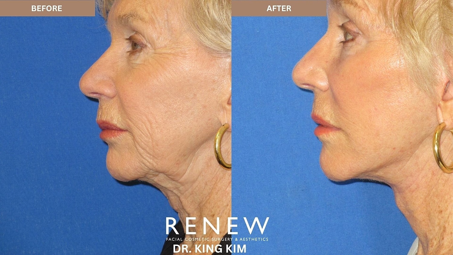 Deep Plane Facelift Before & After