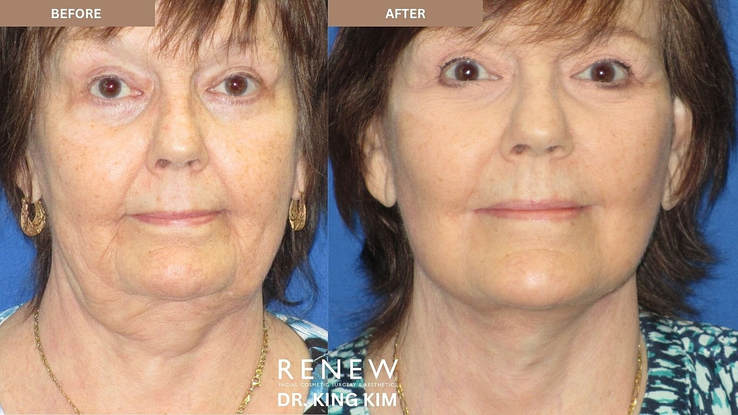 Deep Plane Facelift Before & After