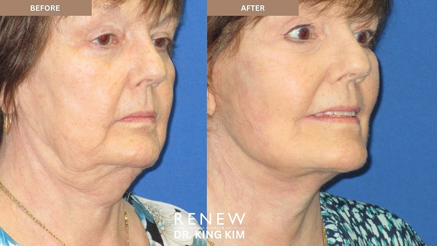 Deep Plane Facelift Before & After