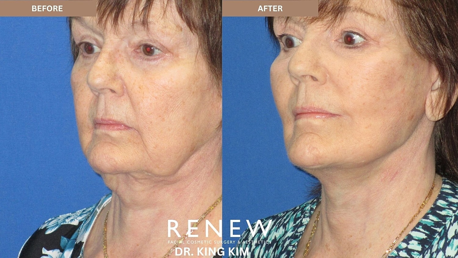 Deep Plane Facelift Before & After