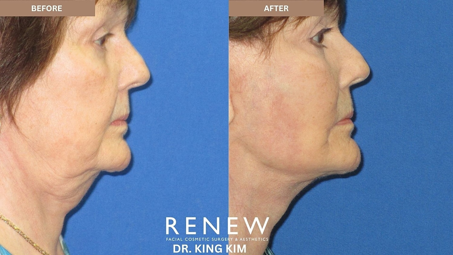 Deep Plane Facelift Before & After