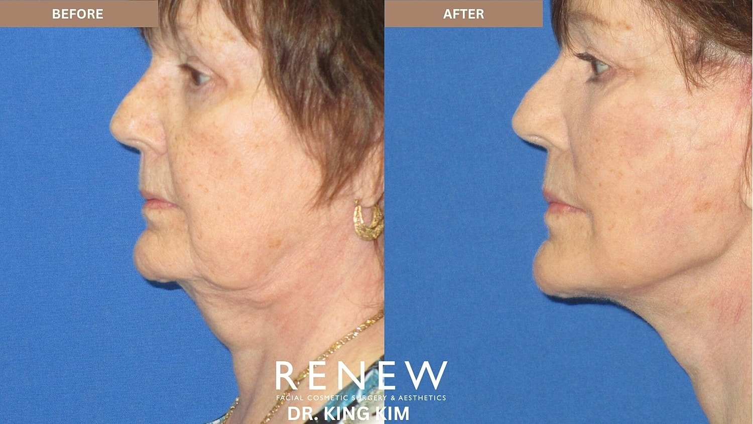 Deep Plane Facelift Before & After