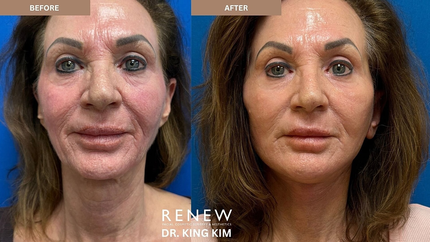 Deep Plane Facelift Before & After