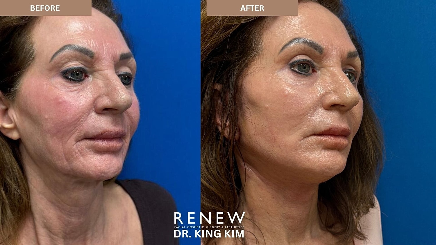 Deep Plane Facelift Before & After