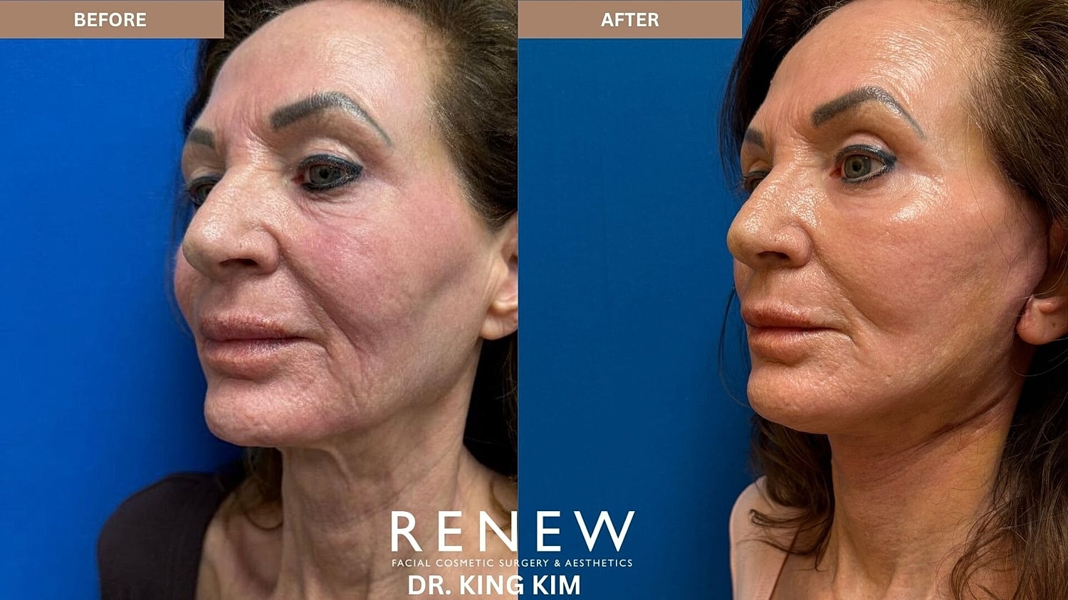 Deep Plane Facelift Before & After