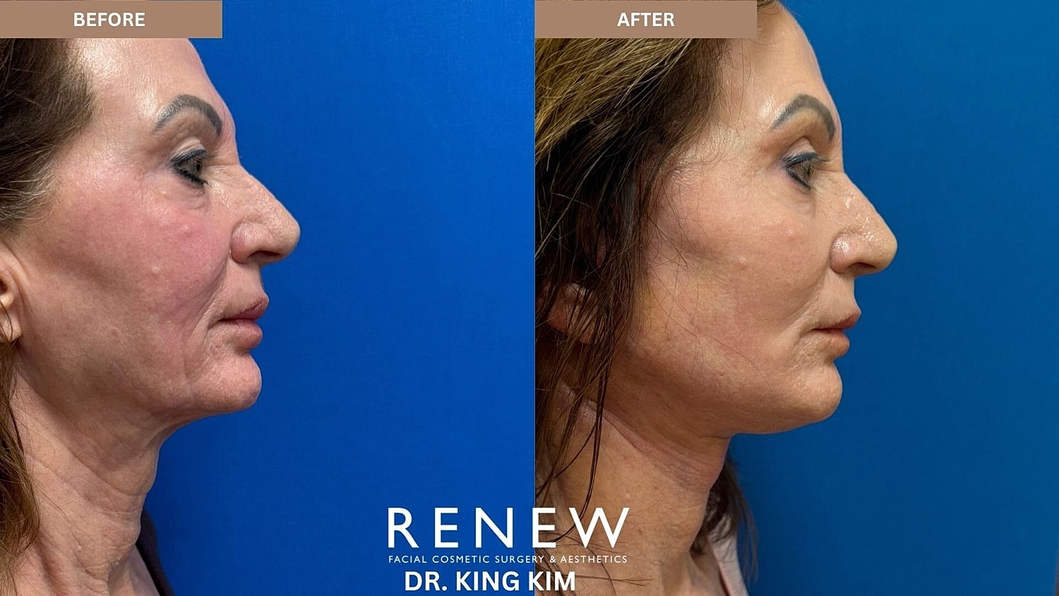 Deep Plane Facelift Before & After