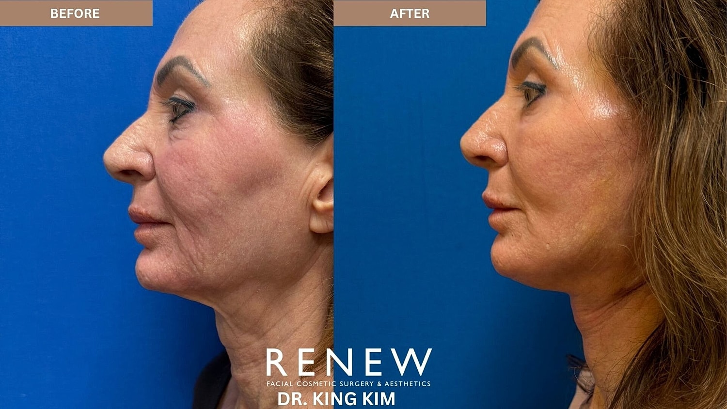 Deep Plane Facelift Before & After