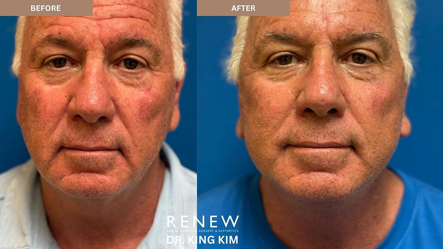 Deep Plane Facelift Before & After