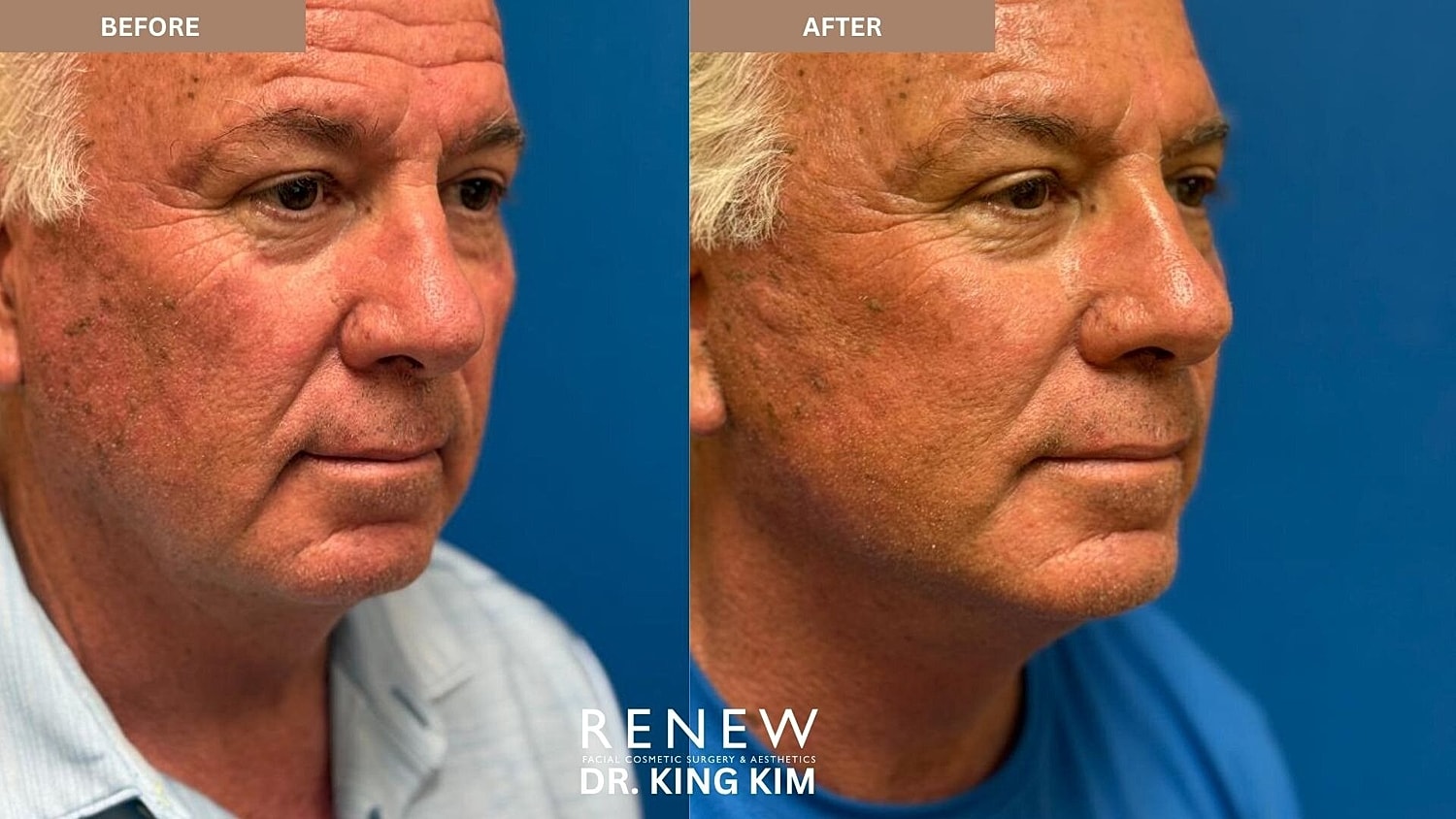 Deep Plane Facelift Before & After