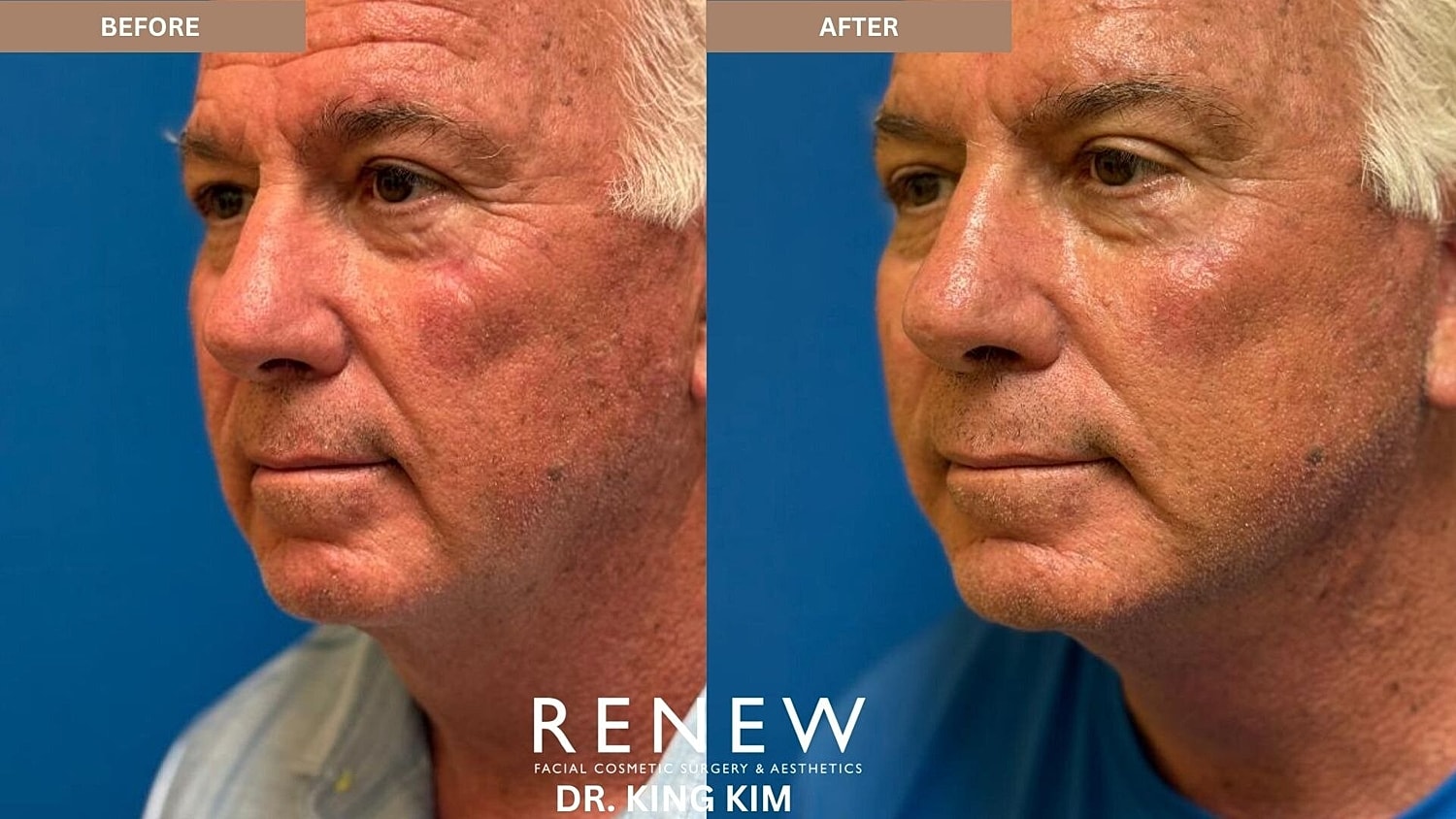 Deep Plane Facelift Before & After