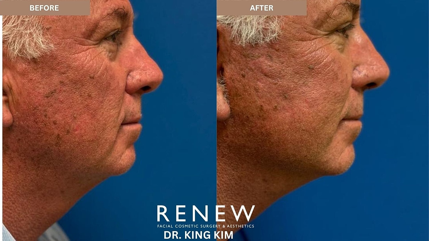 Deep Plane Facelift Before & After