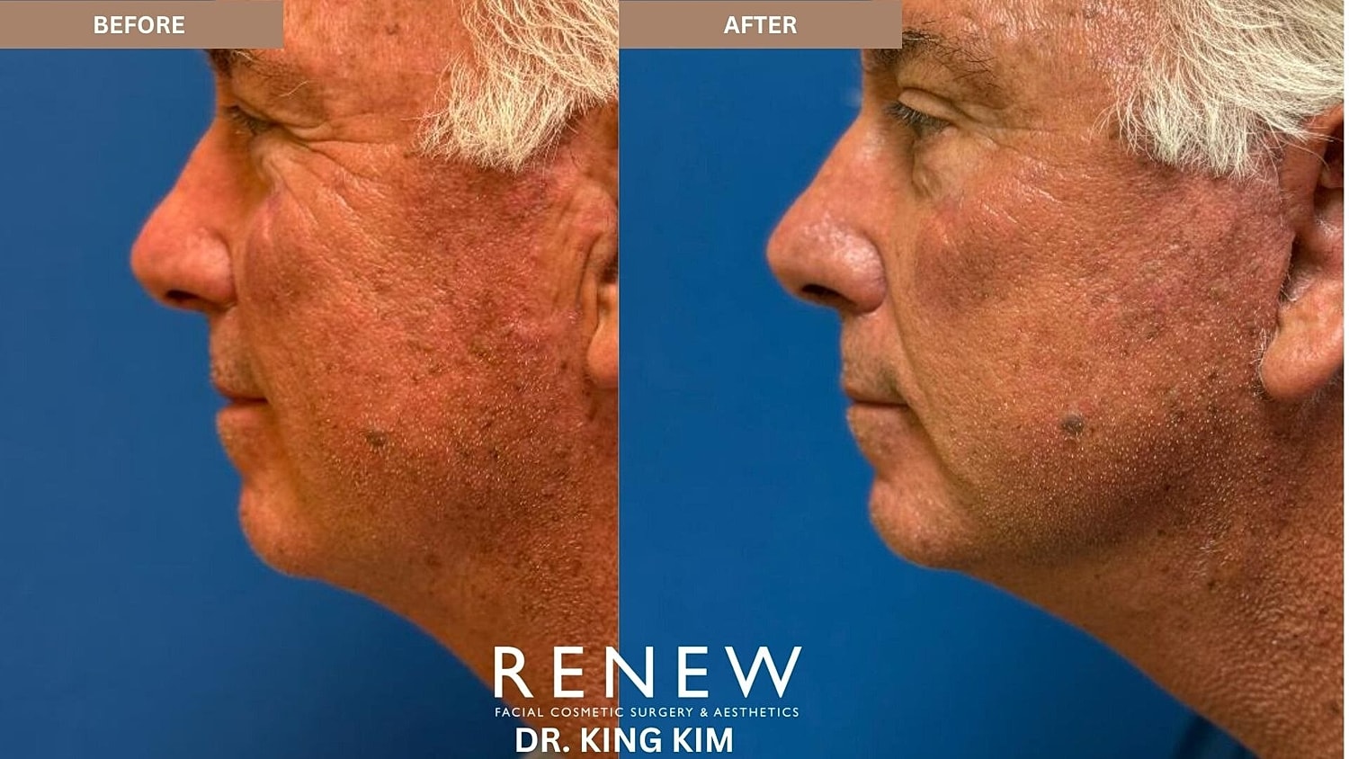 Deep Plane Facelift Before & After