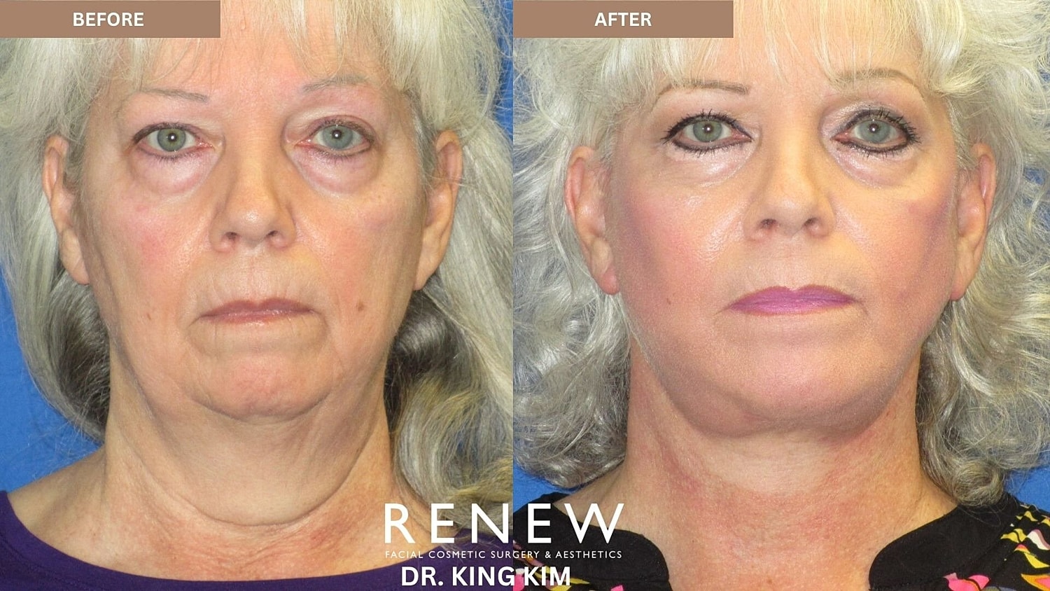 Deep Plane Facelift Before & After