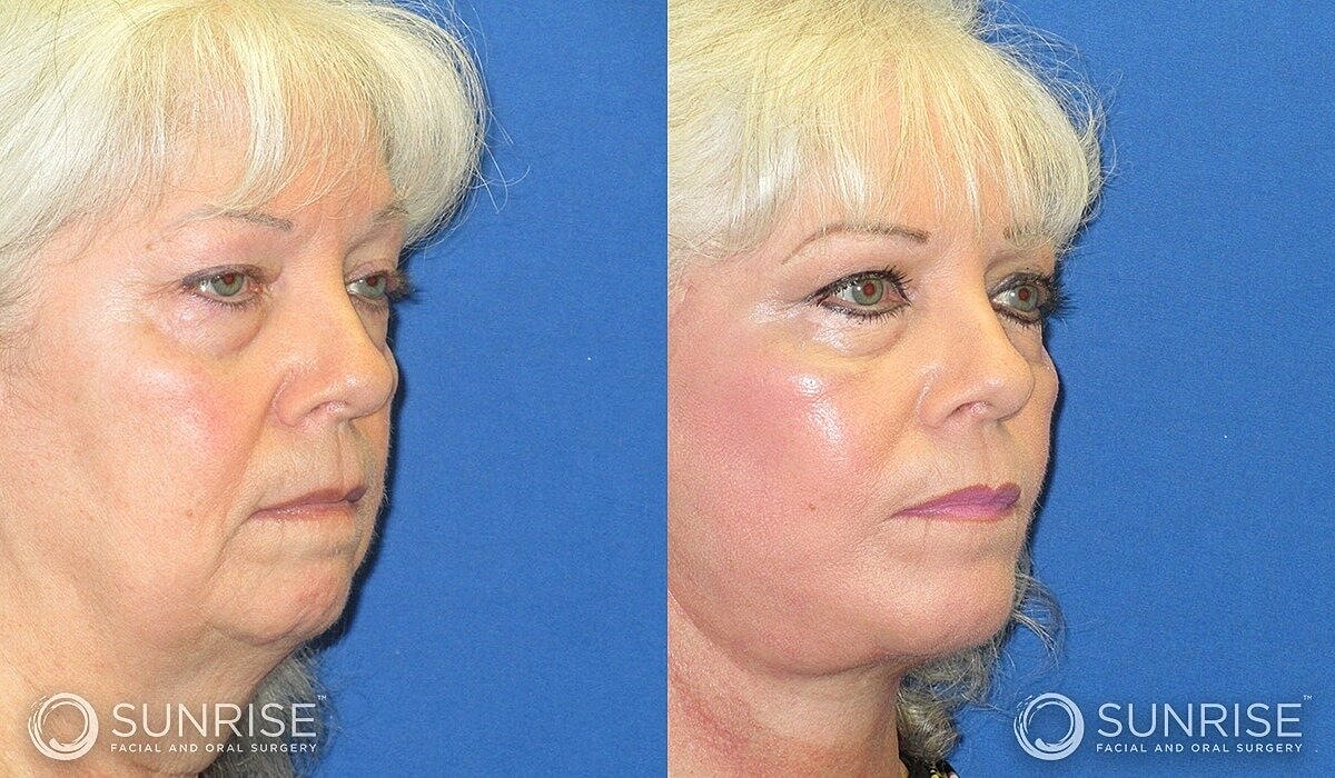 Deep Plane Facelift Before & After