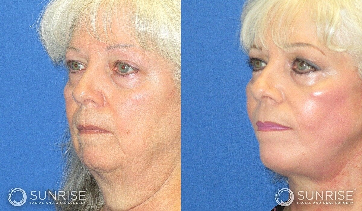 Deep Plane Facelift Before & After