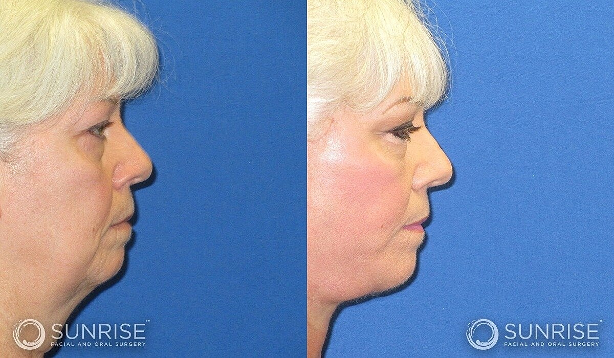 Deep Plane Facelift Before & After