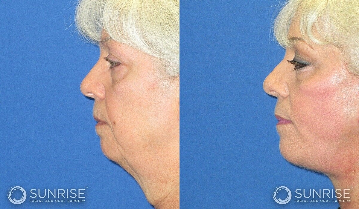 Deep Plane Facelift Before & After