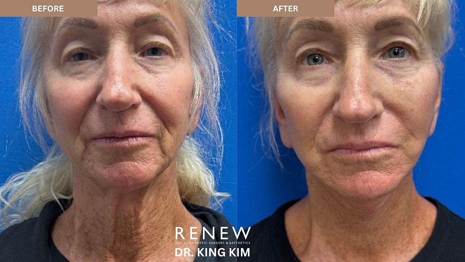 Deep Plane Facelift Before & After