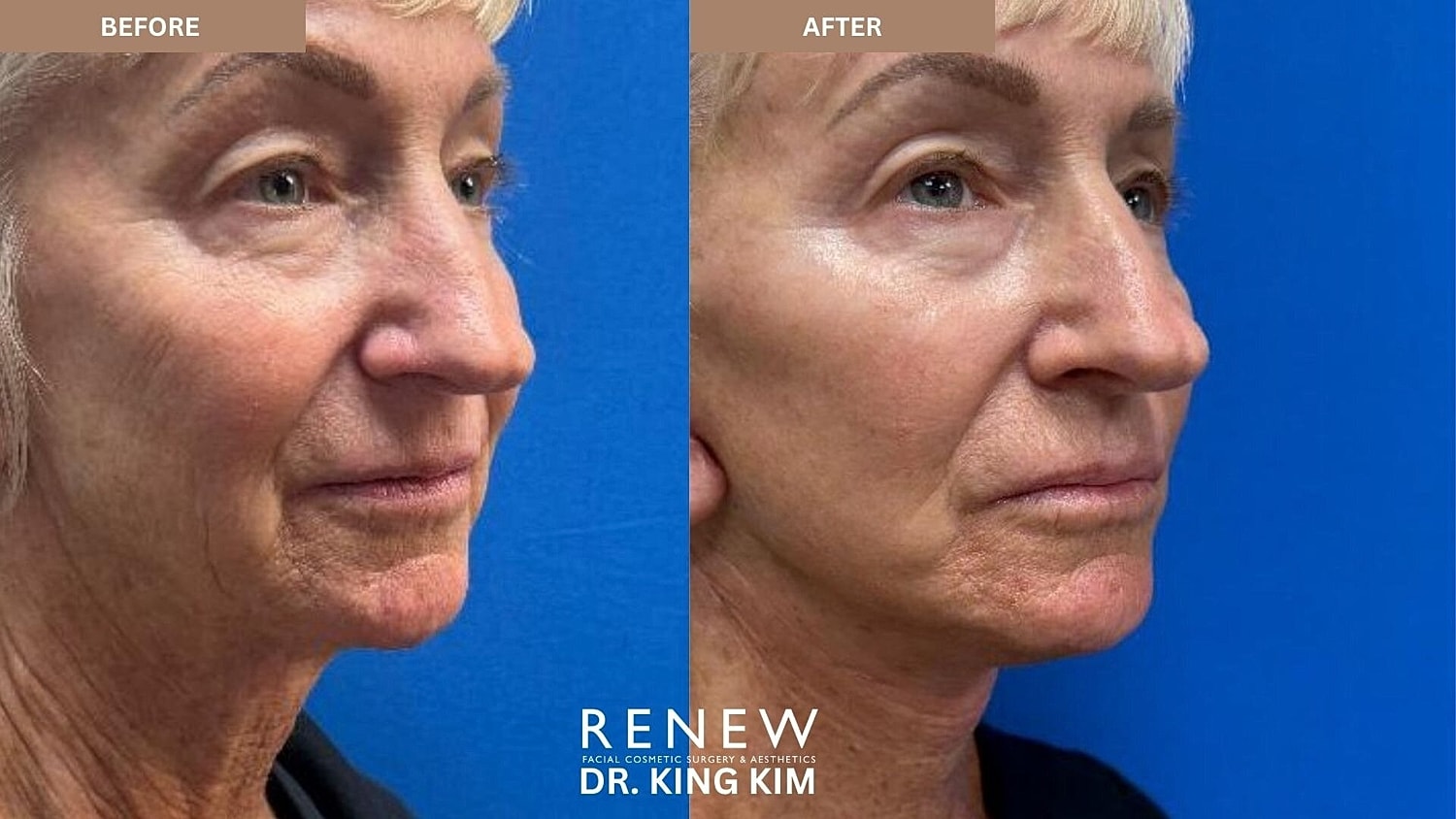Deep Plane Facelift Before & After