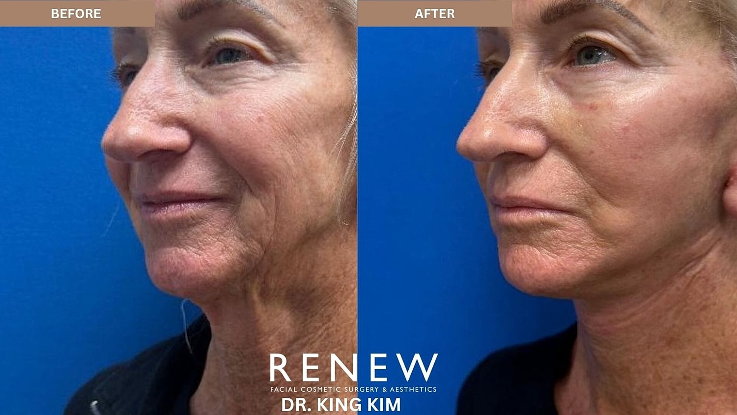 Deep Plane Facelift Before & After