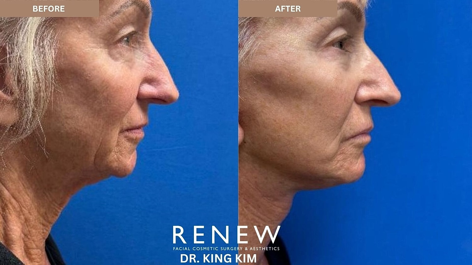 Deep Plane Facelift Before & After
