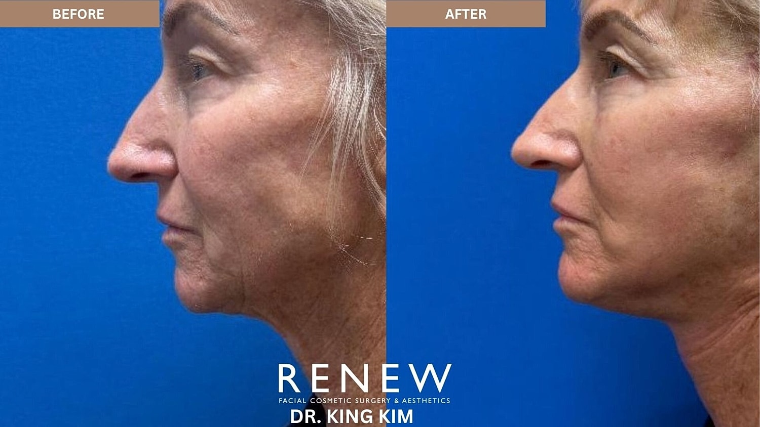 Deep Plane Facelift Before & After