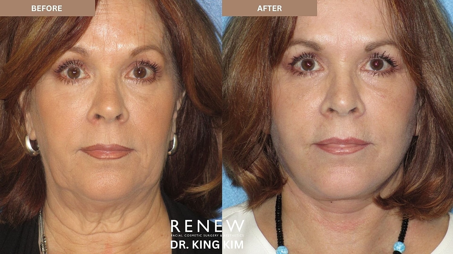 Deep Plane Facelift Before & After