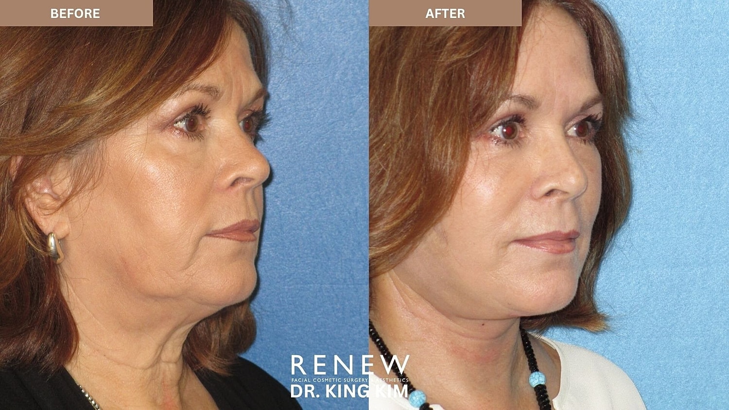 Deep Plane Facelift Before & After