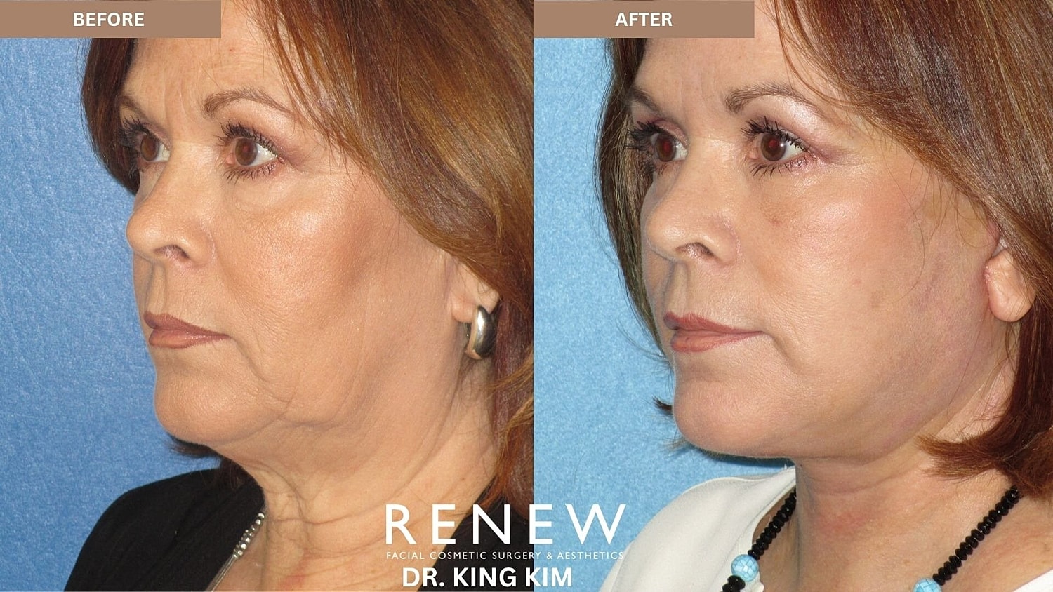 Deep Plane Facelift Before & After