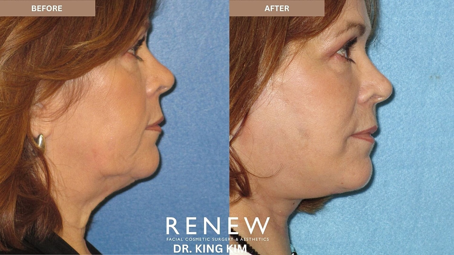 Deep Plane Facelift Before & After