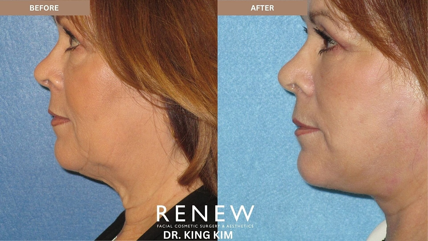 Deep Plane Facelift Before & After