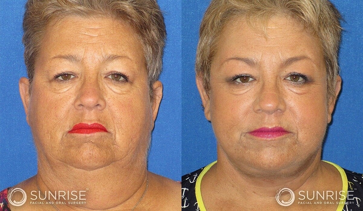 Deep Plane Facelift Before & After