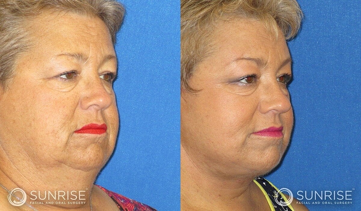 Deep Plane Facelift Before & After
