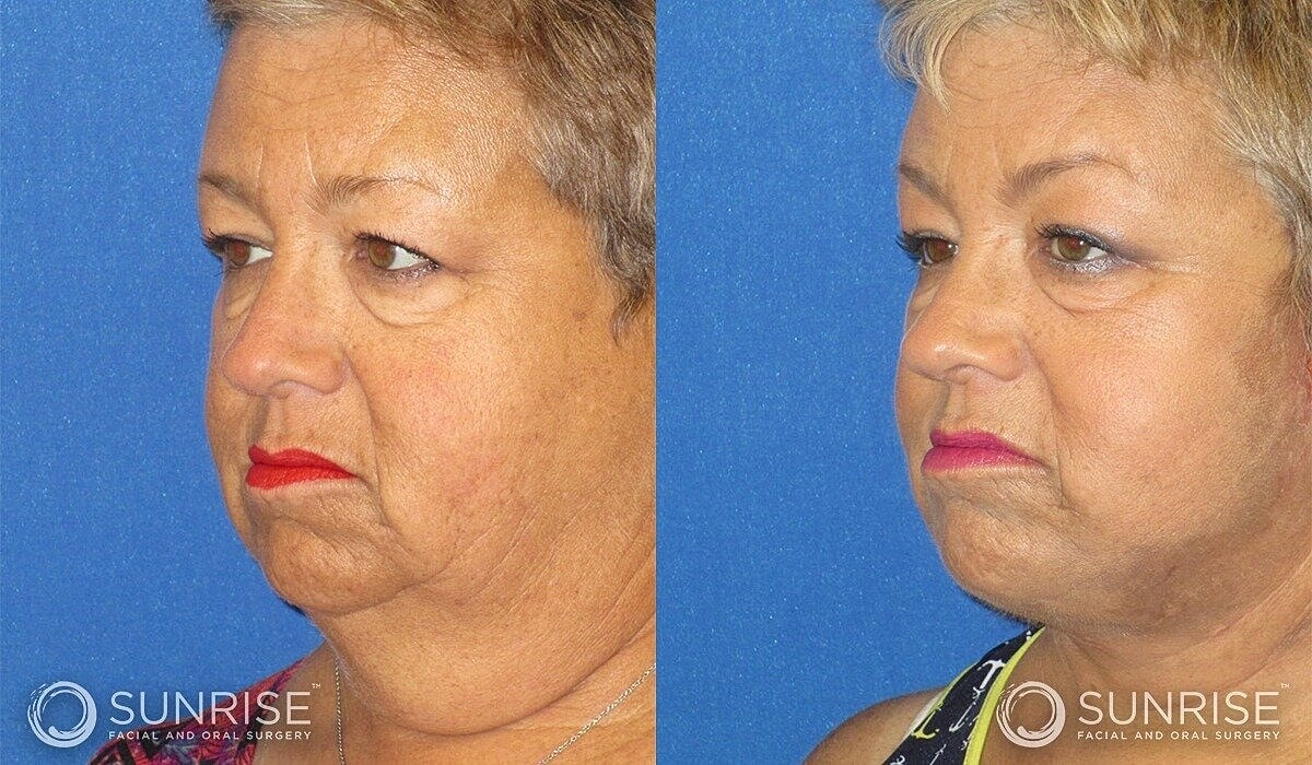 Deep Plane Facelift Before & After