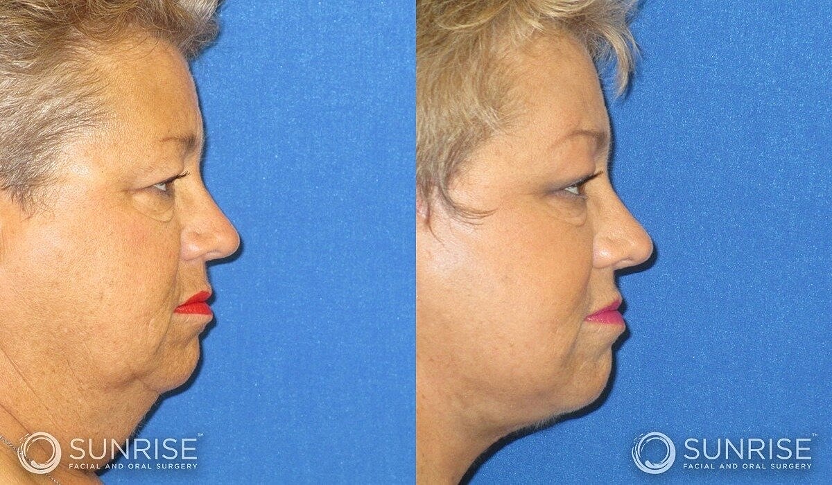 Deep Plane Facelift Before & After