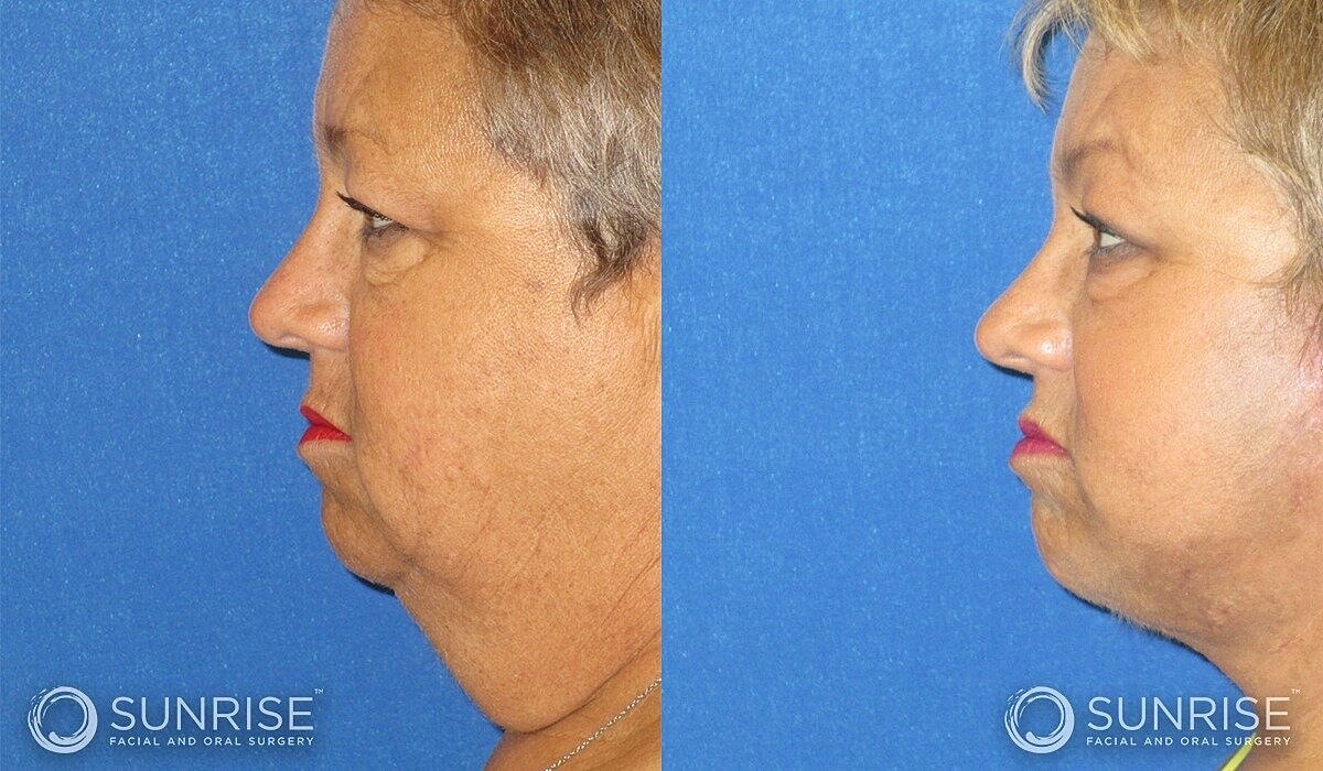 Deep Plane Facelift Before & After