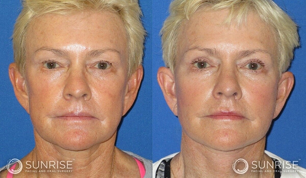 Deep Plane Facelift Before & After