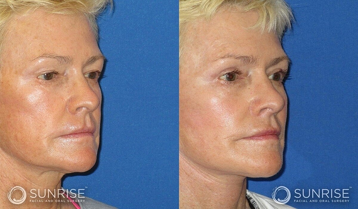 Deep Plane Facelift Before & After