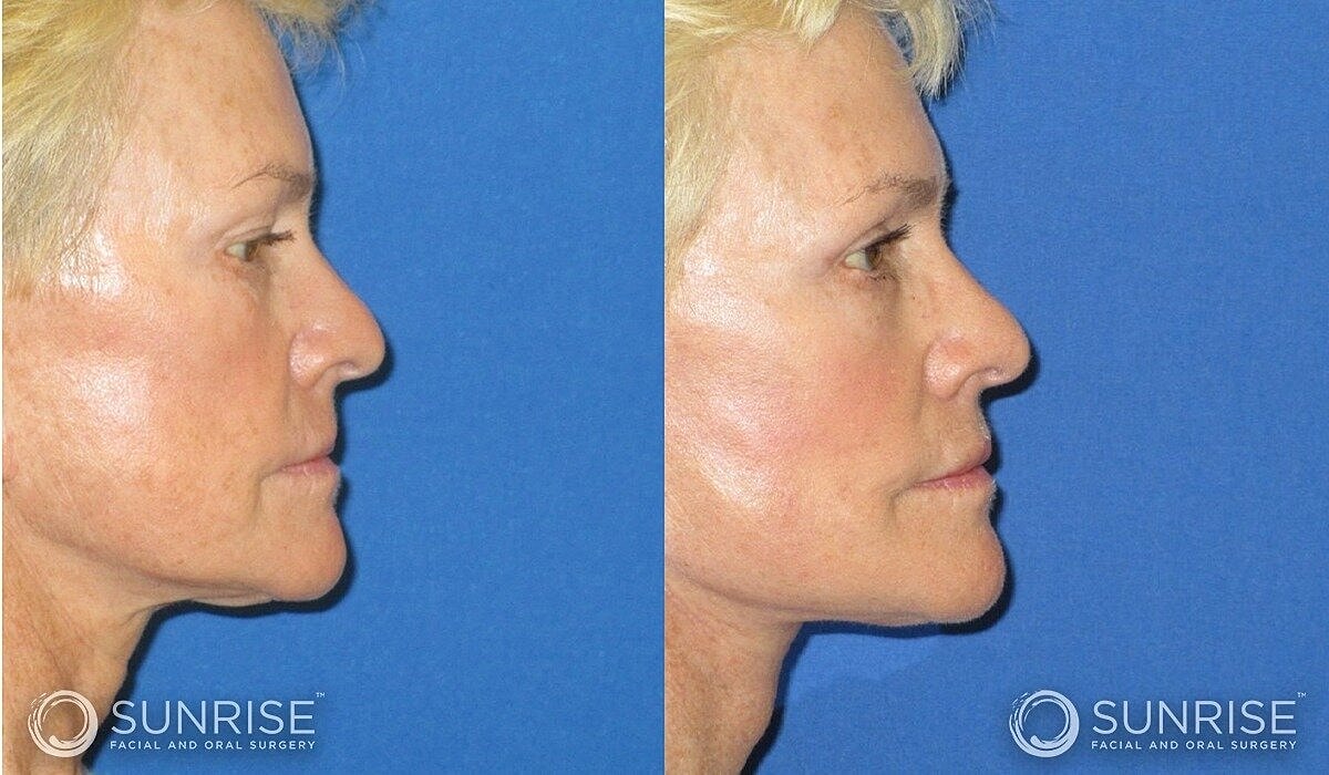 Deep Plane Facelift Before & After